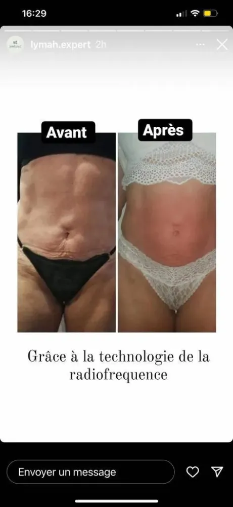 avant apres Slim