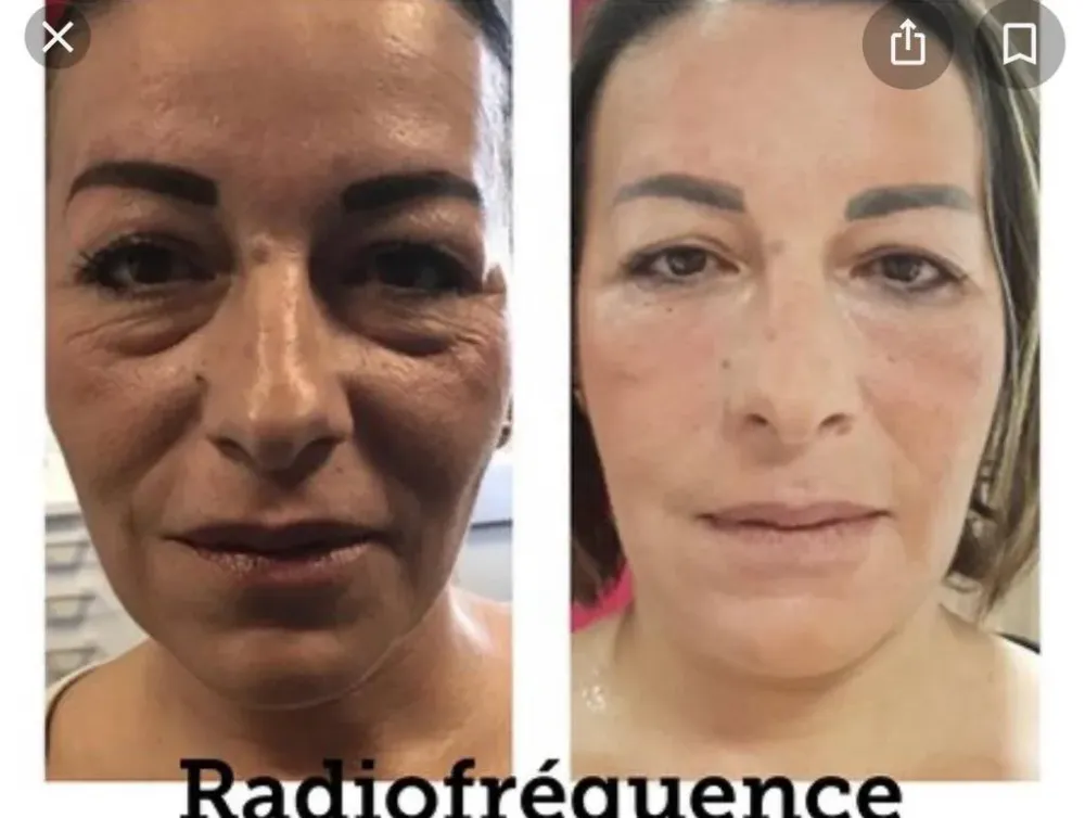 rédiofrequencewebp