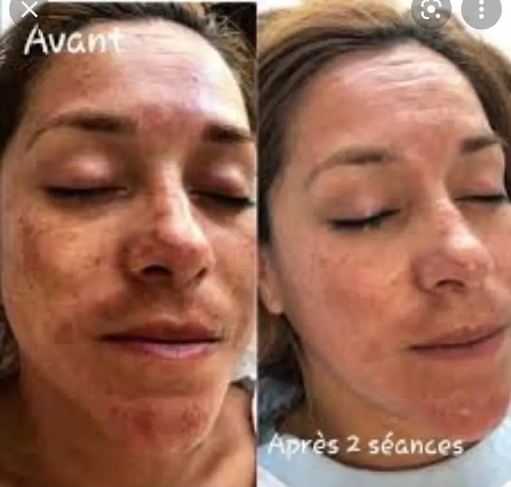 avant apres Jetpeel