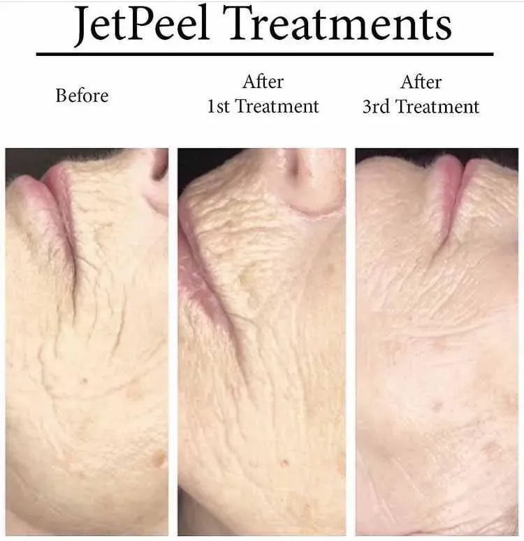 traitement Jetpeel